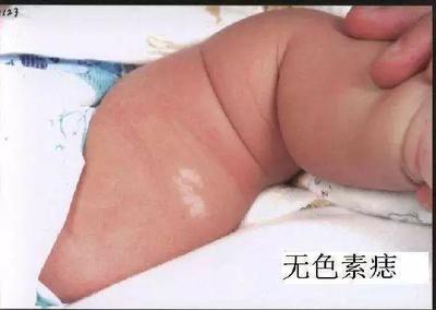 宝宝无色素痣