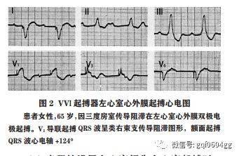 左心室阻滞是怎么回事