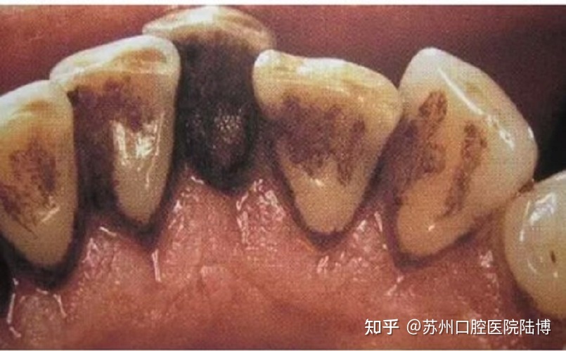 牙周炎早期怎么治疗