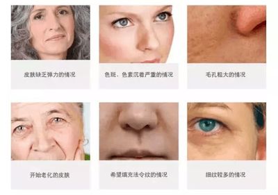 脸上有痘痘能打水光针吗