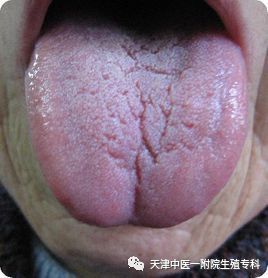 舌尖裂纹是怎么回事