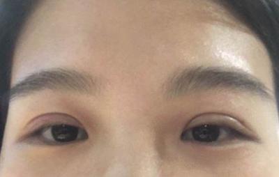 双眼皮太肿