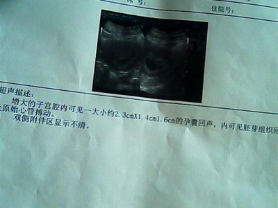 怀孕多久可见孕囊