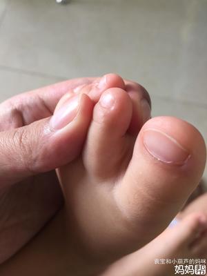 宝宝有脚气怎么办用什么药好