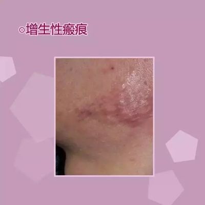 隆起的大痘痘