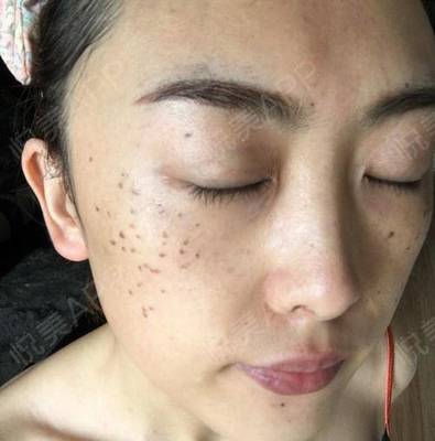 激光祛斑 术后