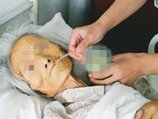 低温症怎么治疗