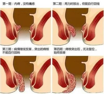 内痔二期怎么治疗