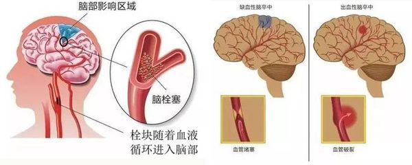 大血管堵塞怎么治疗