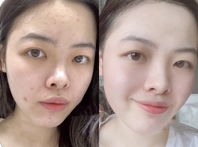 痘痘肌多久用一次清洁
