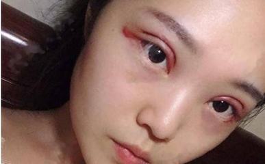 割完双眼皮肉条没知觉