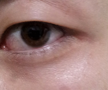 结膜炎是怎么回事
