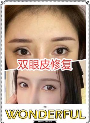 如何有双眼皮