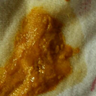 新生儿蛋花样大便