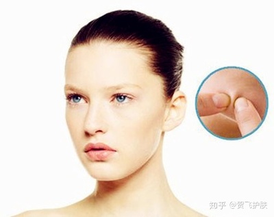 痘痘怎样挤才算挤干净