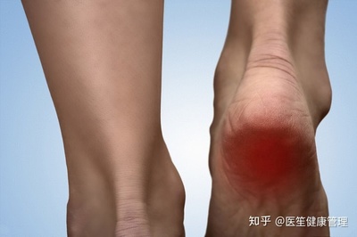 跖筋膜炎怎么治疗