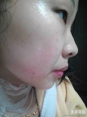 有红血丝 痘痘