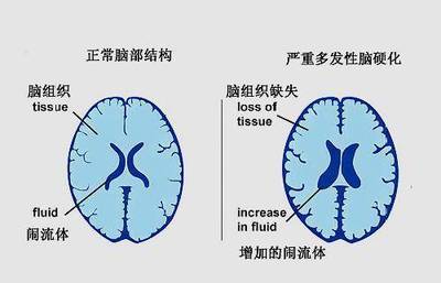 大脑萎缩是怎么回事