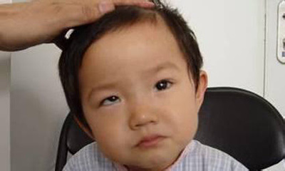 小孩斜视怎么治疗