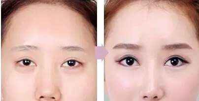 割双眼皮了能吃鸡蛋吗