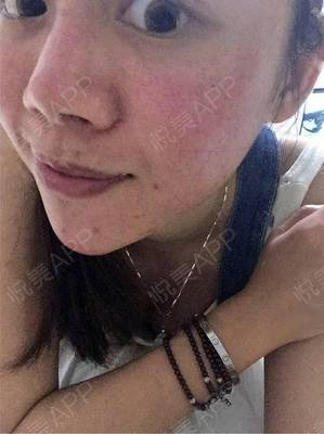 祛痘痘痘印的app软件
