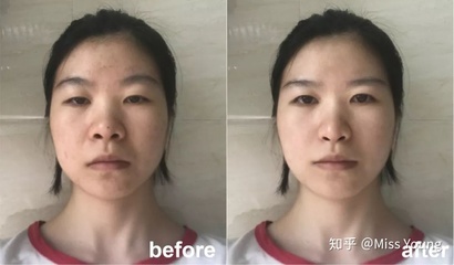痘痘肌可以光子嫩肤吗