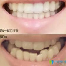 矫正牙齿前后