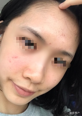 额头两侧发黑是怎么回事