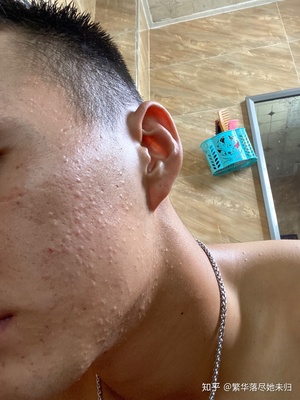 脸上长满小痘痘