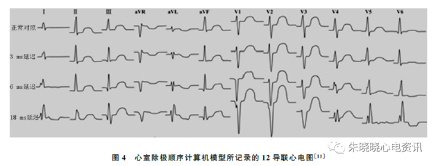 左心室阻滞是怎么回事