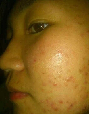 脸上的痘痘一直发炎怎么办
