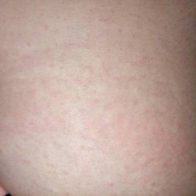 身体上红色痘痘痒