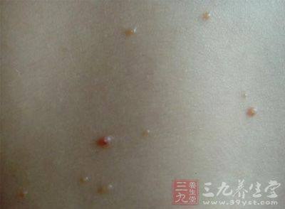 休息不好后背长痘痘