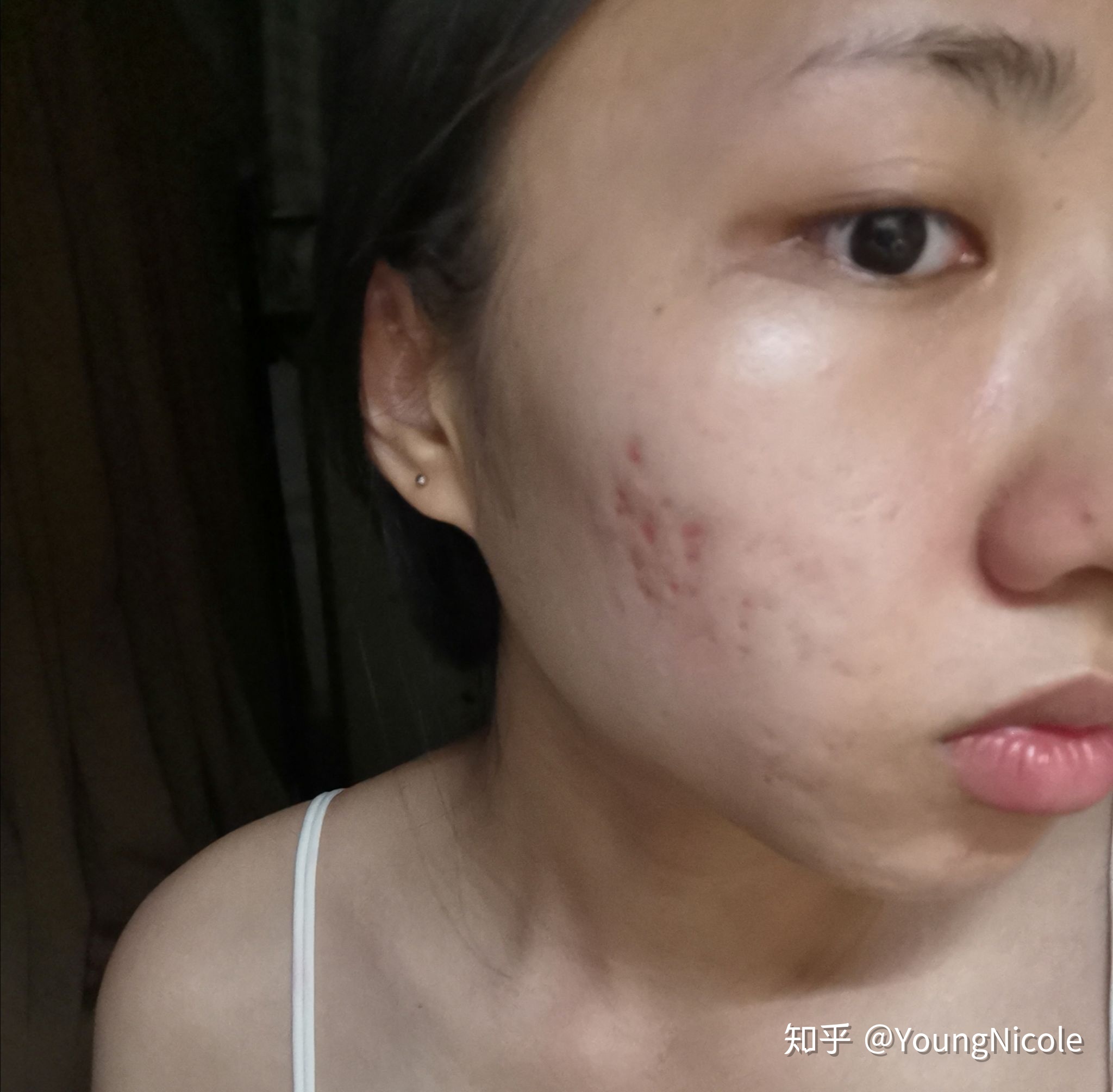 吃什么可以去痘印
