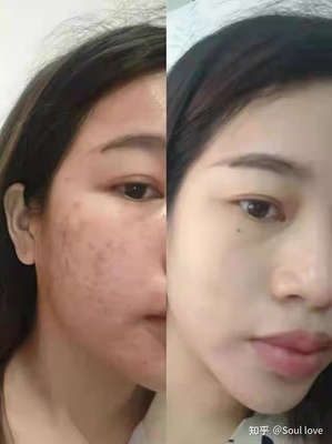 长痘痘应该忌口什么
