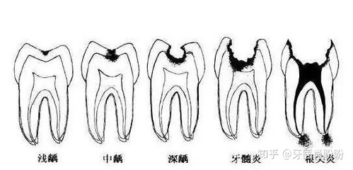 蛀牙拔了一定要种牙吗