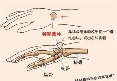 什么是腱鞘炎怎么治疗