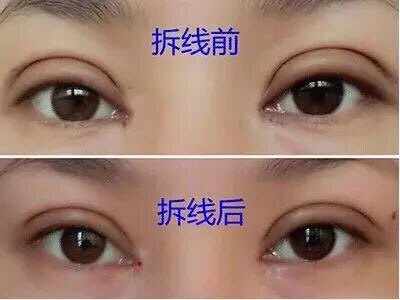 做了埋线双眼皮怎么消肿快