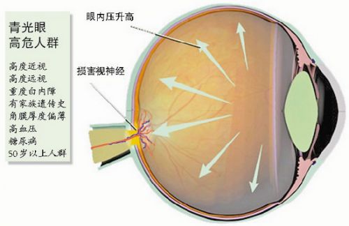 青光眼做小梁切除术要多少钱