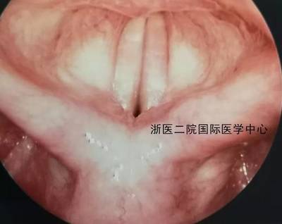 喉咙里面有白点是怎么回事