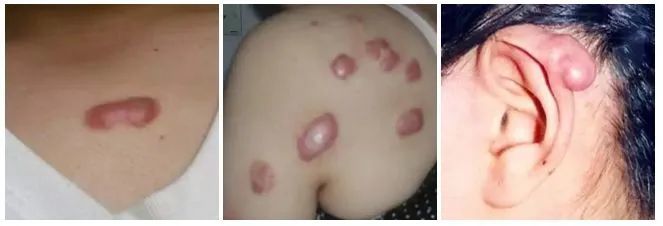痘痘怎么能治好