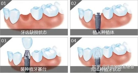 种牙好还是镶牙好