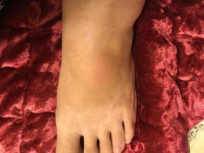 腱鞘囊肿脚上怎么治疗