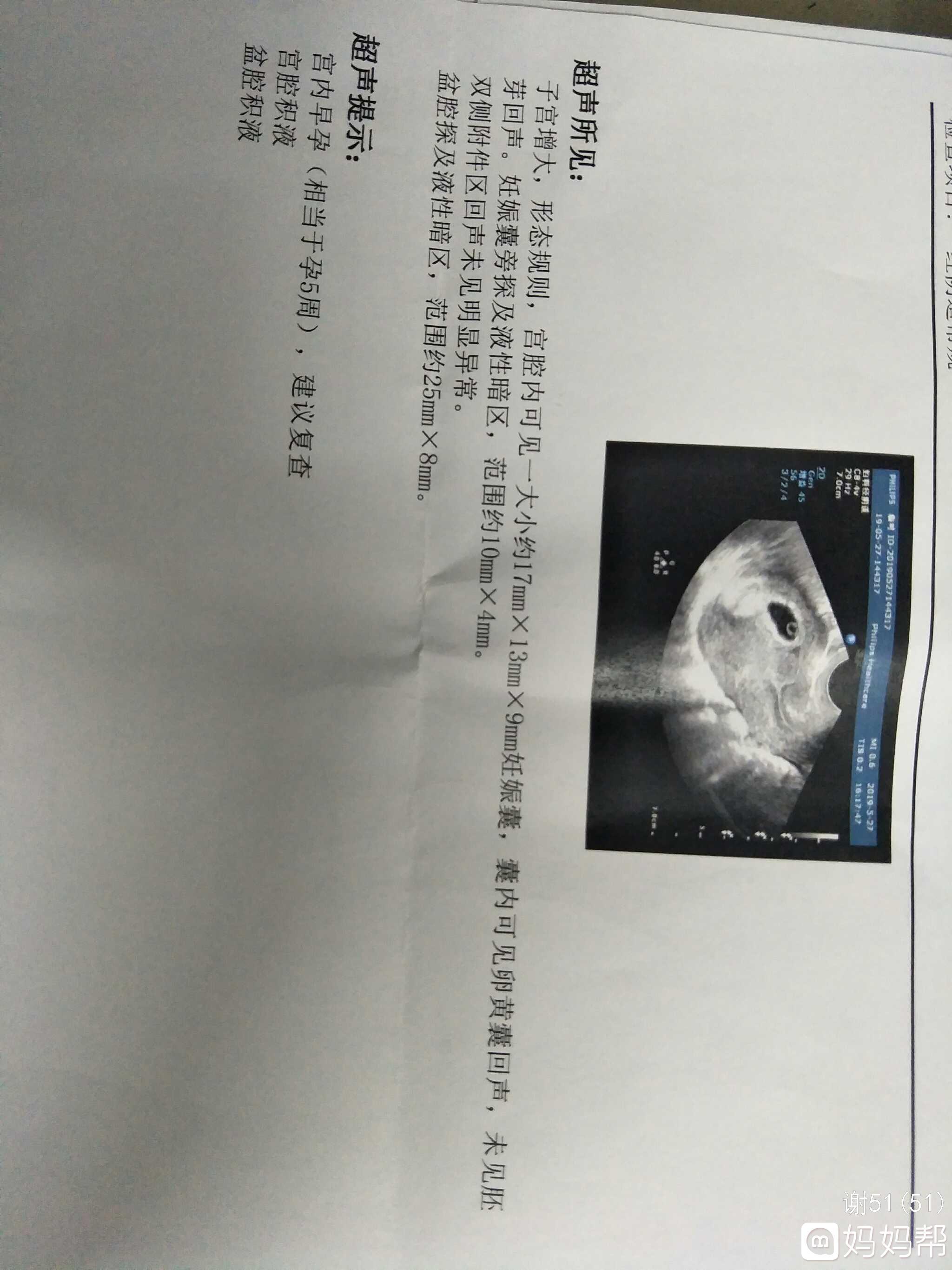 宫腔积液可以怀孕吗