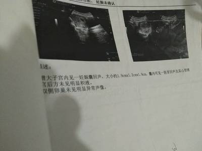 孕囊周围积液多少算多