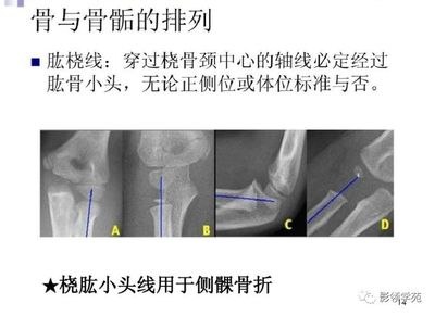 骨颈骨折后几个月能好
