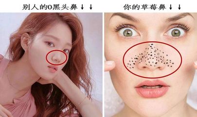 粉刺挤掉好还是不挤好