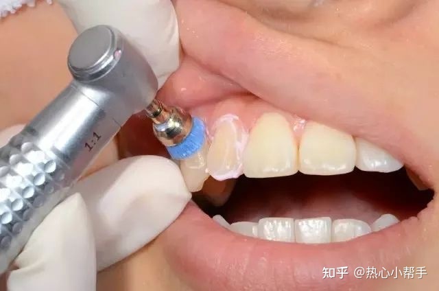 洗牙没有抛光