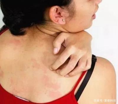 后背起痘痘良方