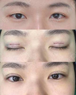 眼皮为什么一单一双